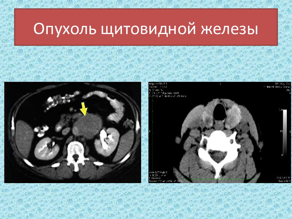 Опухоль железа. Гиперплазия щитовидной железы кт.