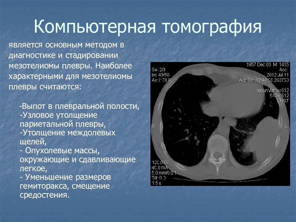 Гидроторакс на кт. Междолевой плеврит на кт. Междолевой гидроторакс. Выпот в плевральной полости кт.