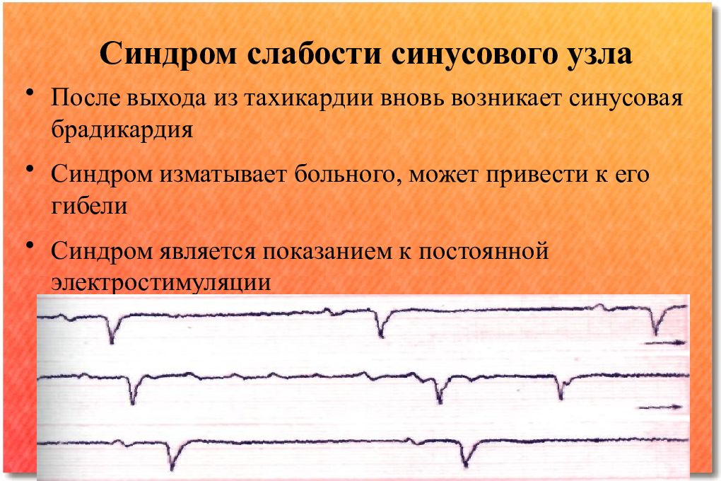 Синдром слабости синусового узла карта вызова смп