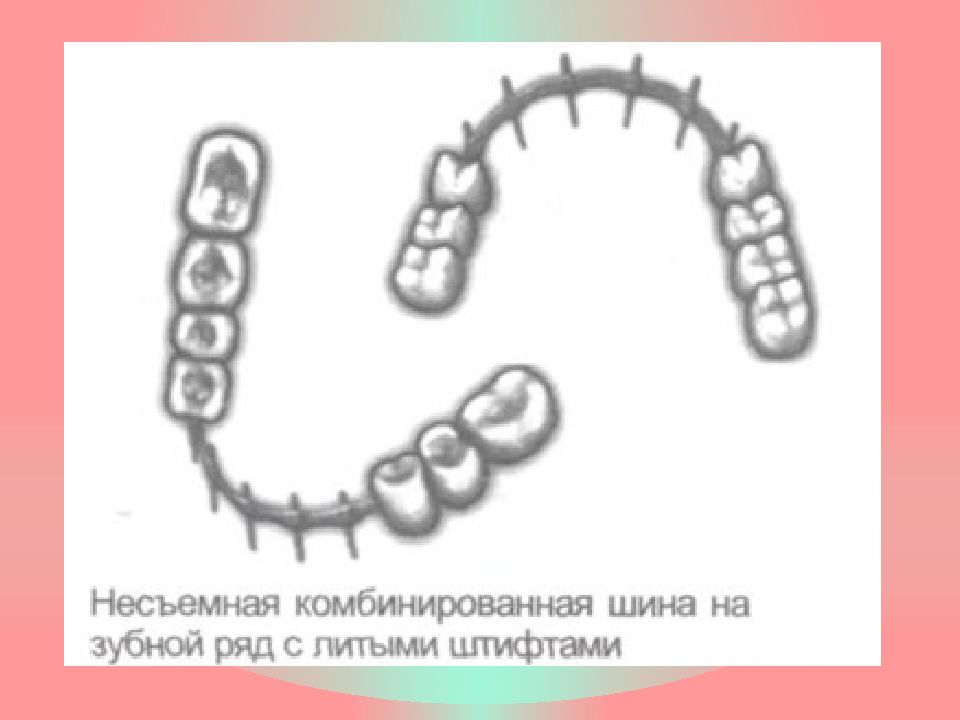 Постоянное шинирование при заболеваниях пародонта презентация