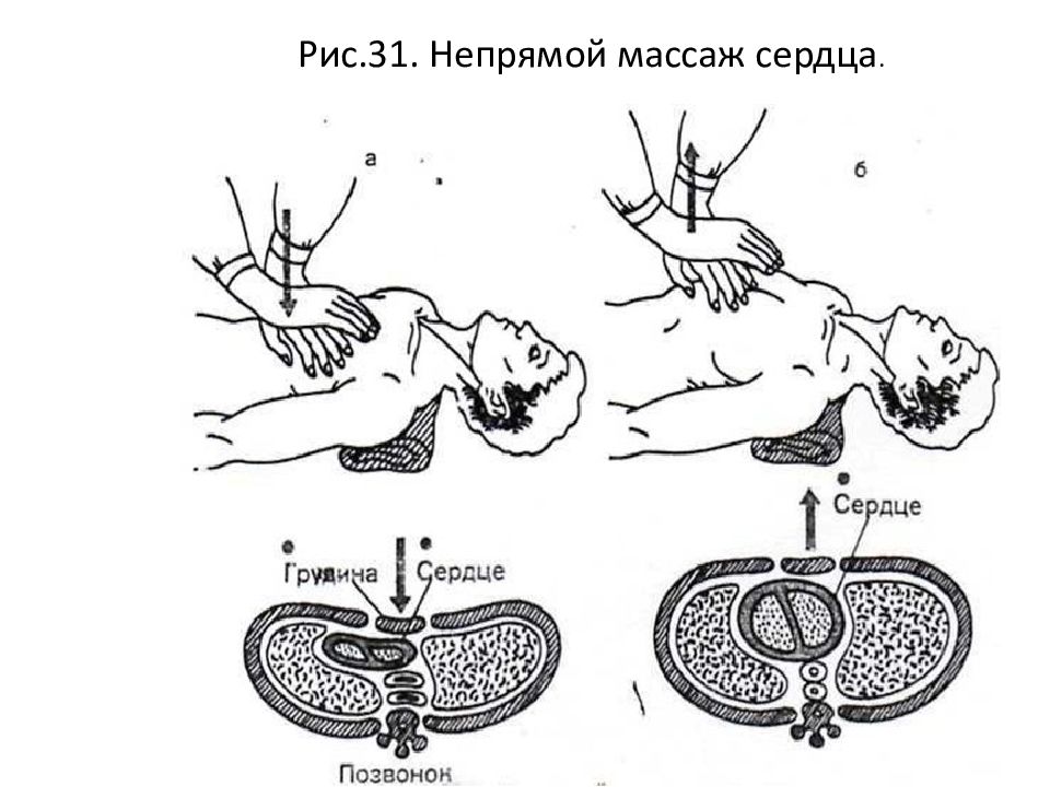 Непрямой массаж сердца. Схема проведения наружного массажа сердца. Схема непрямого массажа сердца. Схема проведения непрямого массажа сердца. Наружный непрямой массаж сердца.