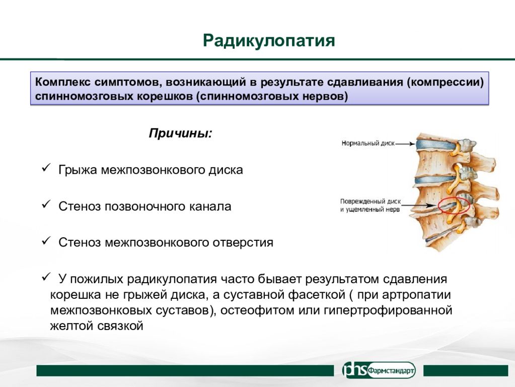 Компрессия корешков поясничного отдела