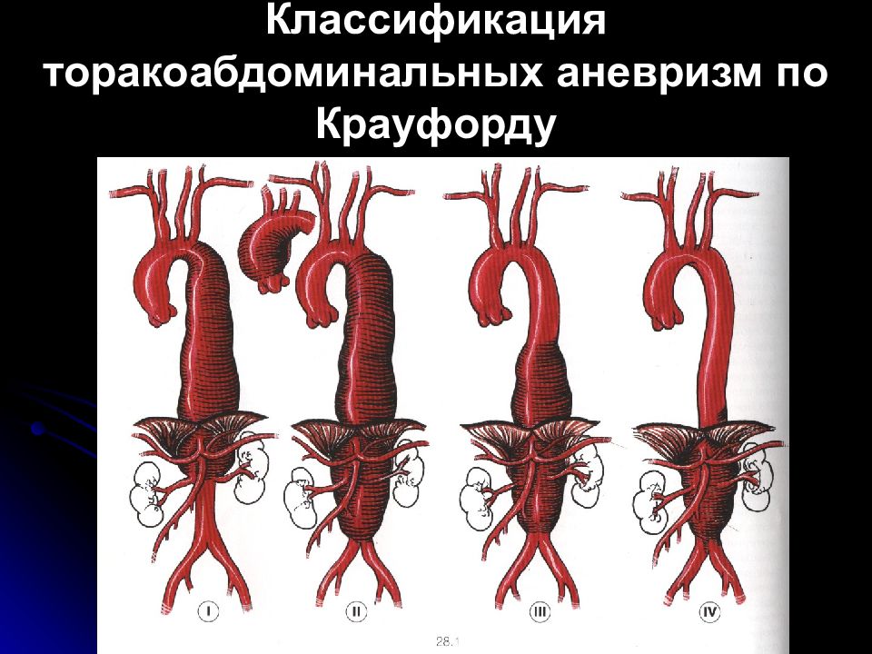 Аневризмы аорты презентация