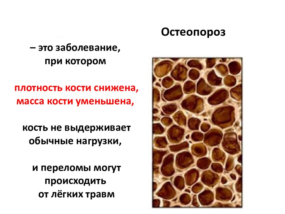 Высокая плотность костей. Плотность человеческой кости. Остеопороз плотность кости. Измерение плотности костей. Плотность кости приостеопарозе.