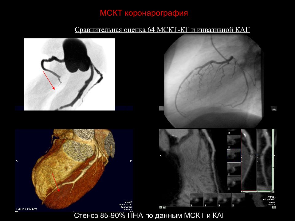 Пна. Мультиспиральная компьютерная томография коронарография. Коронарография стеноз ПНА.