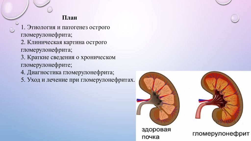Сестринский процесс при гломерулонефрите. Сестринский процесс при остром гломерулонефрите. Патогенез гломерулонефрита. Острый гломерулонефрит диагностика.