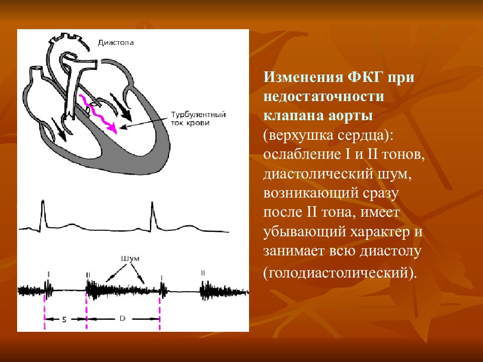 Аускультативная картина i тона сердца при стенозе устья аорты