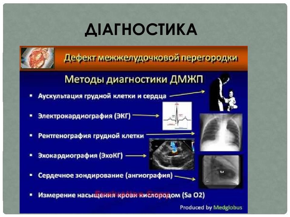 Дефект межжелудочковой перегородки. Дефект межжелудочковой перегородки ЭКГ. ДМЖП клиническая картина. Диагностические критерии ДМЖП. Дефект межжелудочковой перегородки диагноз.