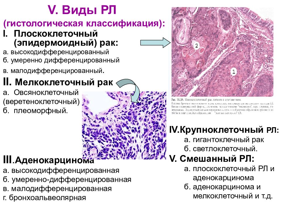 Гистологическая картина плоскоклеточного рака