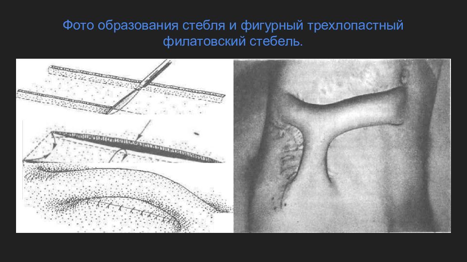 Кожная пластика кожным лоскутом. Кожная пластика Филатовский стебель. Стебельчатый лоскут Филатова. Пластика стеблем Филатова. Техника операции.этапы пластики филатовского стебля.