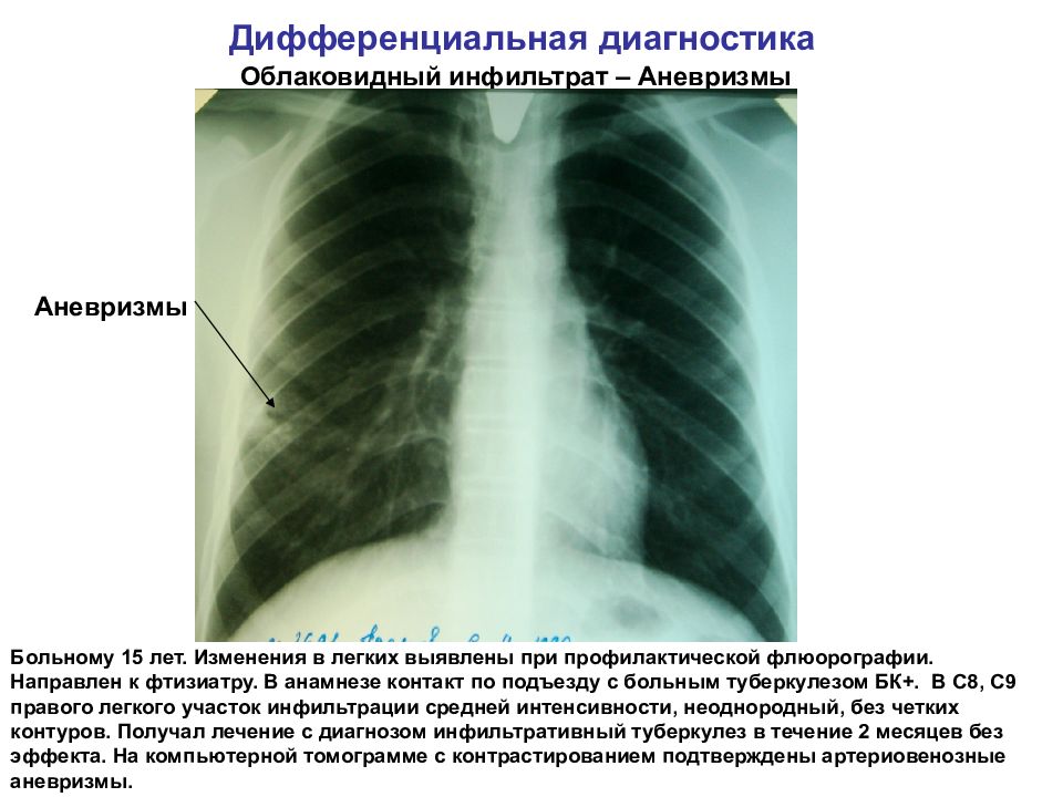 Изменение легочного рисунка на флюорографии что это значит