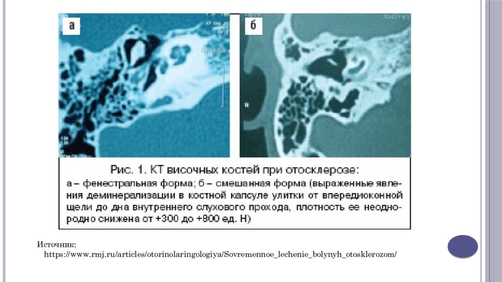 Мрт височных костей режимы. Отосклероз на кт височных костей. Кт височной кости при отосклерозе. Кт височных костей при отосклерозе. Отосклероз височной кости на кт.