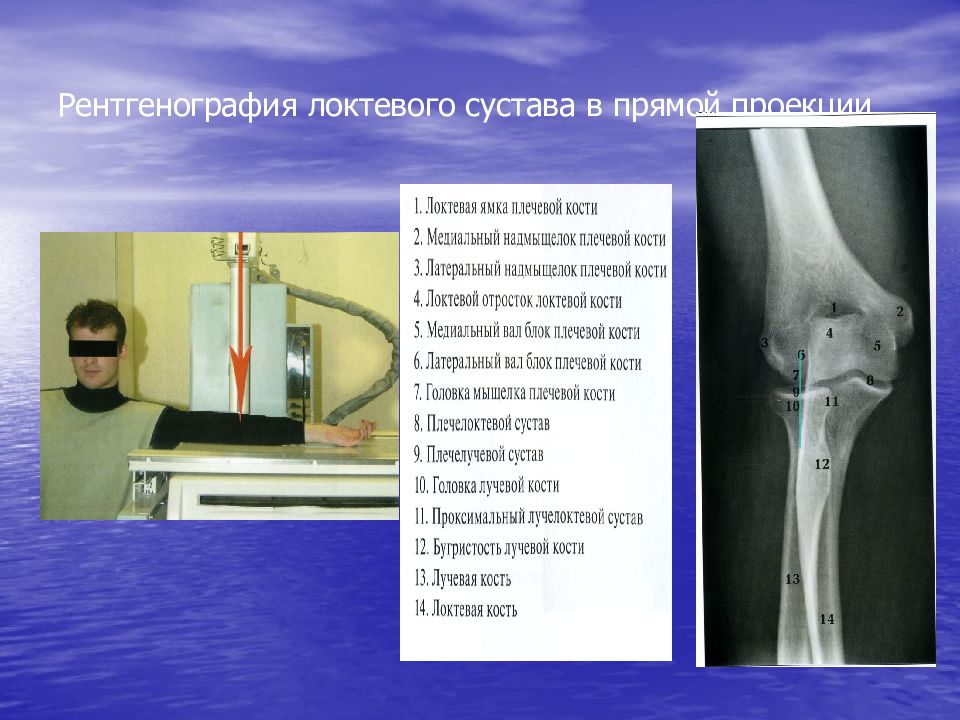 Рентген локтевого сустава. Кости локтевого сустава анатомия рентген. Анатомия костей локтевого сустава рентген. Снимок локтевого сустава в прямой задней проекции. Рентгенограмма трубчатых костей.