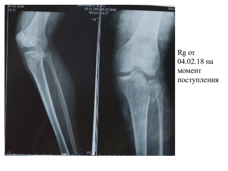 Перелом кости голени мкб 10. Перелом голени презентация. Хирургическое утончение костей голени. Фиброз кости голени. Вальгус большеберцовой кости.
