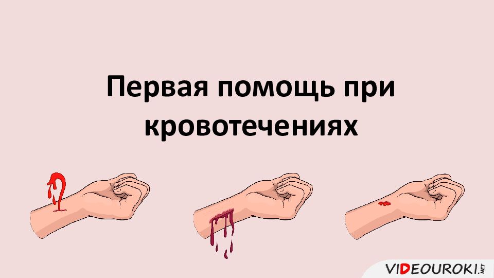 Первая помощь при кровотечениях