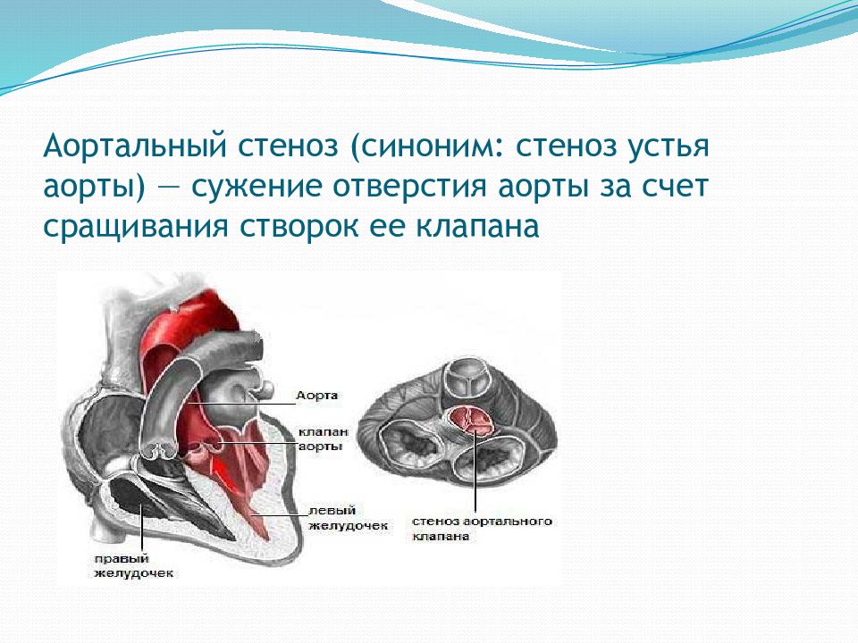 Стеноз аортального клапана. Стеноз аортальный порок лекция. Отверстие аортального клапана. Комиссуры аортального клапана.