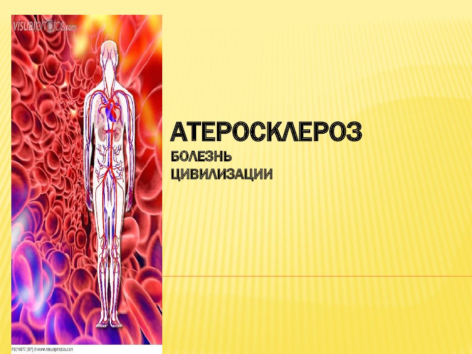 АТЕРОСКЛЕРОЗ БОЛЕЗНЬ ЦИВИЛИЗАЦИИ