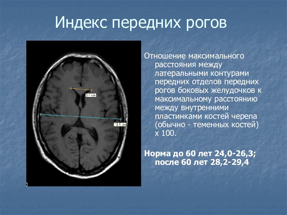 Норма желудочков мозга у взрослых. Ширина желудочков головного мозга на кт. Боковые желудочки головного мозга на мрт. Желудочки мозга норма кт. Индекс 3 желудочка головного мозга.