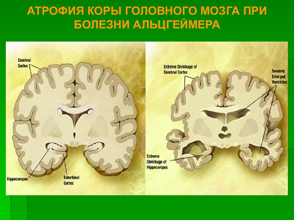 Атрофия головного мозга. Атрофические изменения коры головного мозга. Атрофия коры при болезни Альцгеймера.