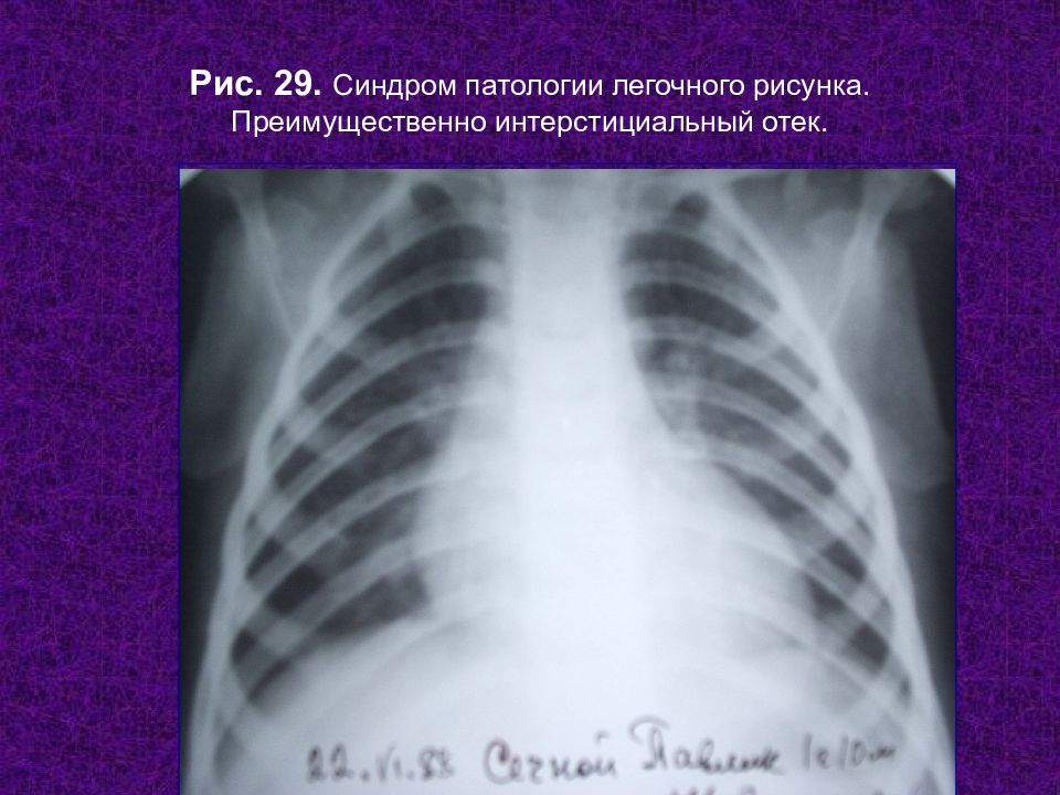 Интерстициальный легочный рисунок. Синдром патологии легочного рисунка. Патология легочного рисунка на рентгенограмме. Патологический легочный рисунок. Изменение легочного рисунка.