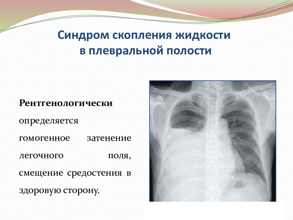 Объясните почему на рентгеновском снимке изображение газа в плевральной полости черное