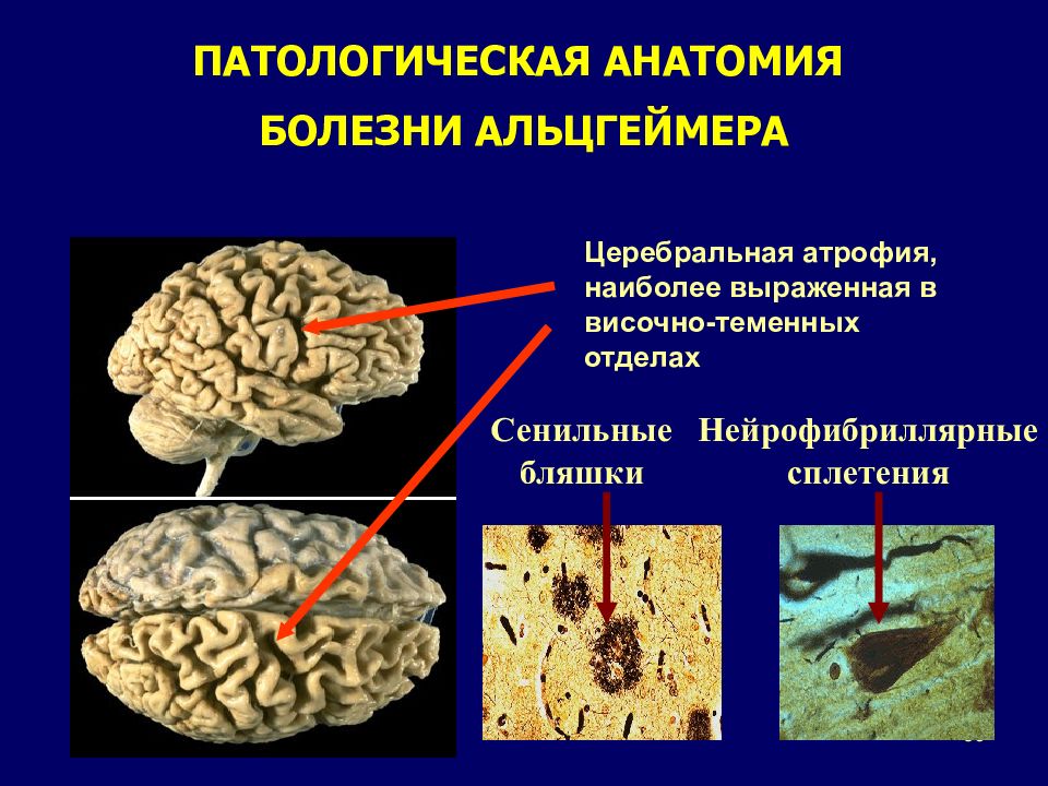 Болезнь альцгеймера патанатомия презентация