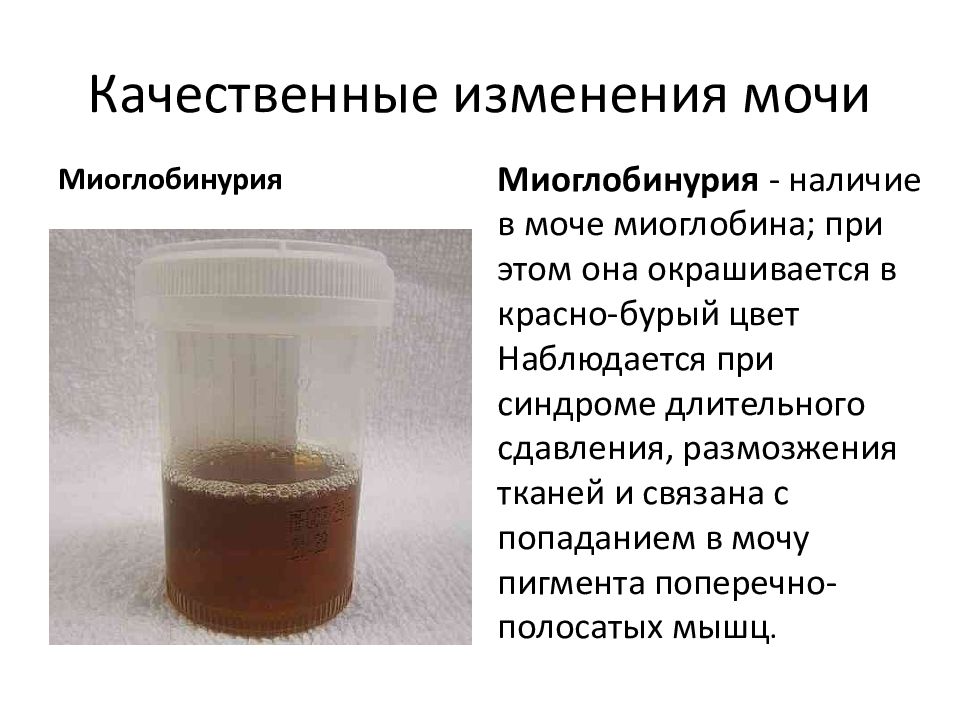 Метронидазол цвет мочи. Моча тёмнгжёллого цвета. Моча нормального цвета. Изменение цвета мочи. Показания к назначению метронидазола.
