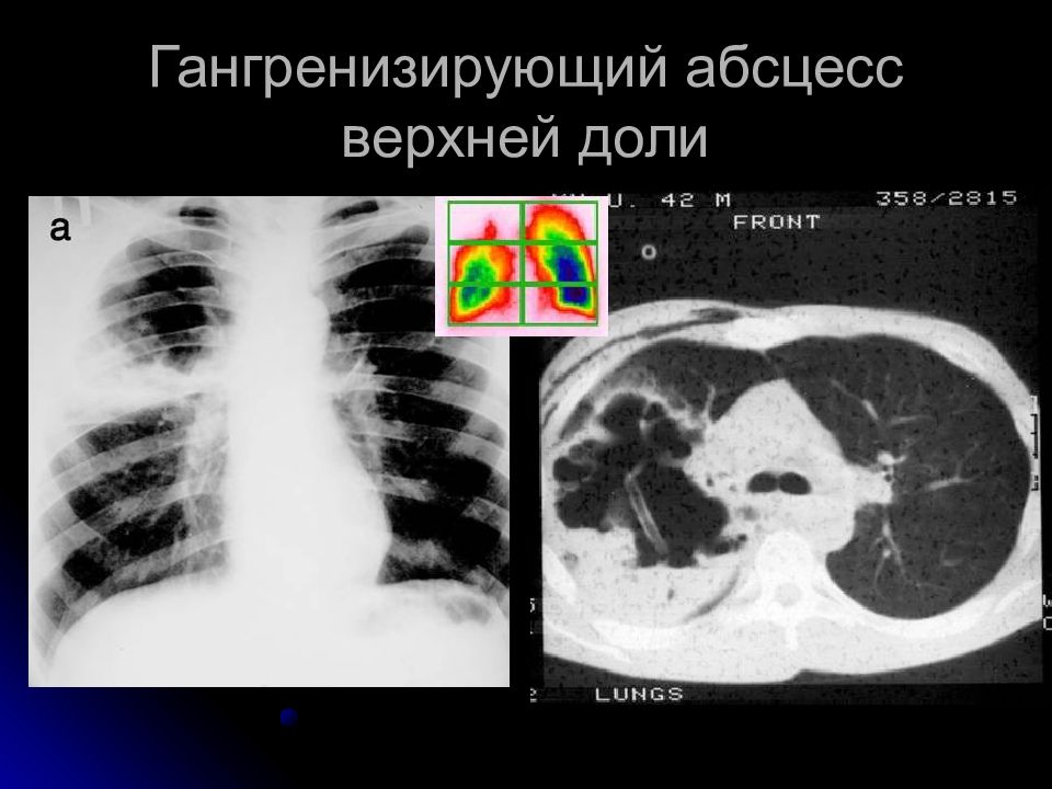 Абсцесс легкого презентация хирургия