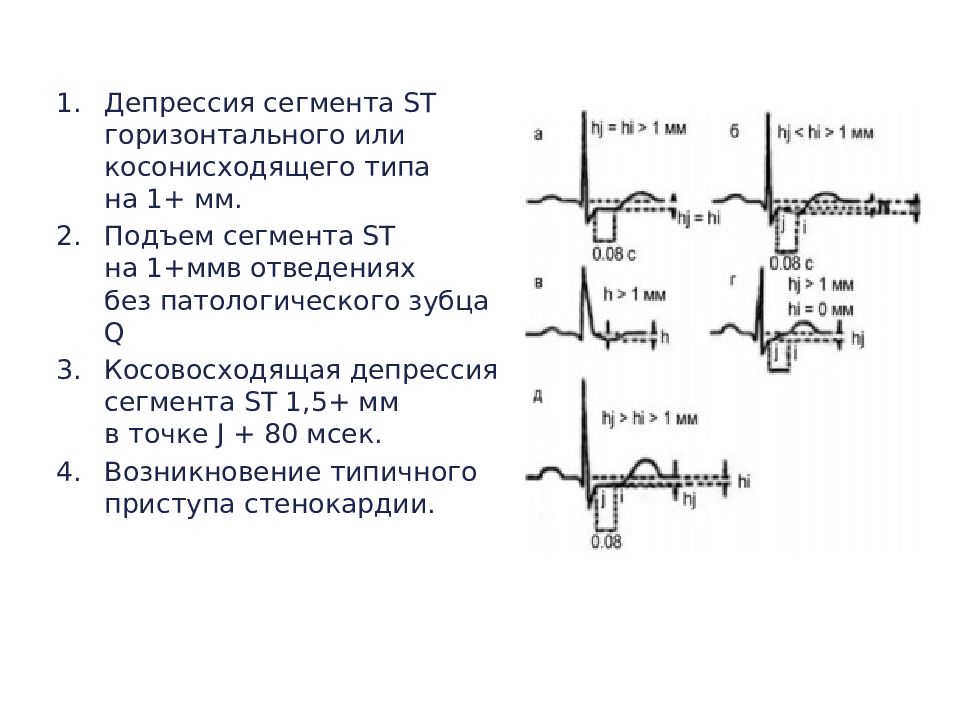 Экг депрессия сегмента