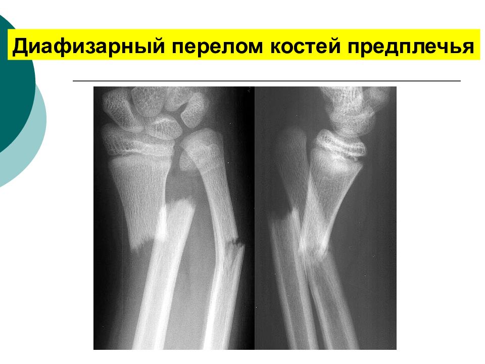 Перелом кости со смещением