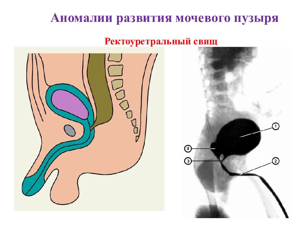 Мочеполовые свищи. Пузырно влагалищный свищ.