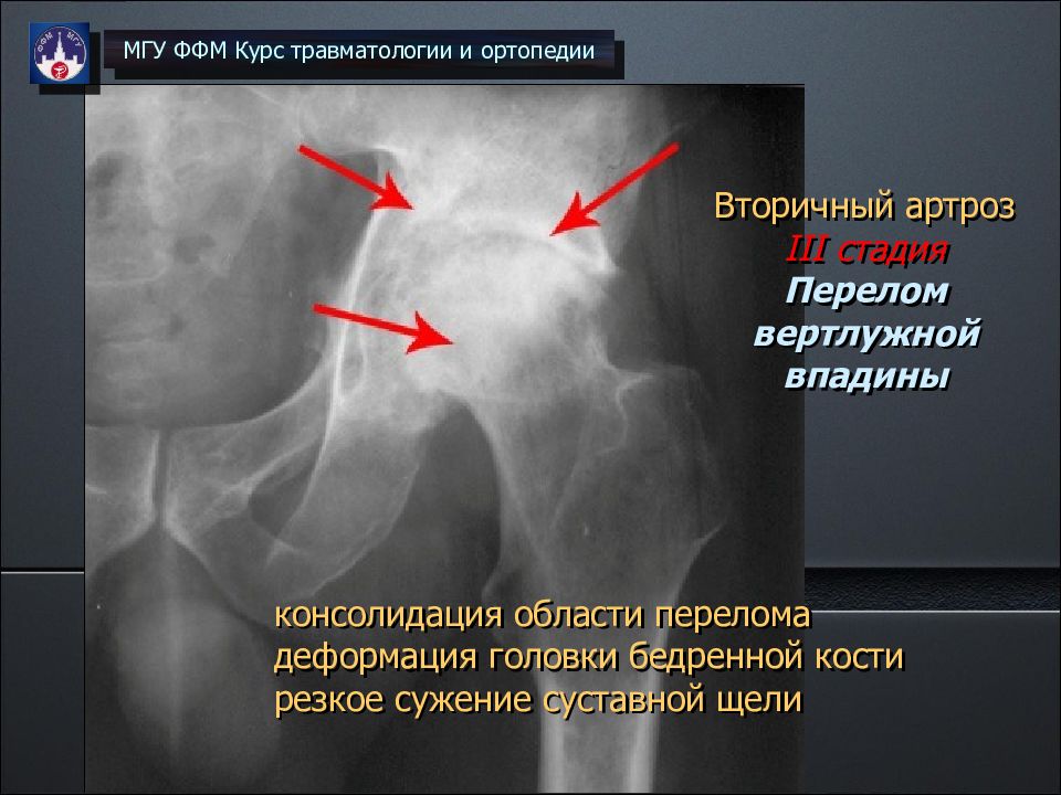 Перелом кости вертлужной впадины