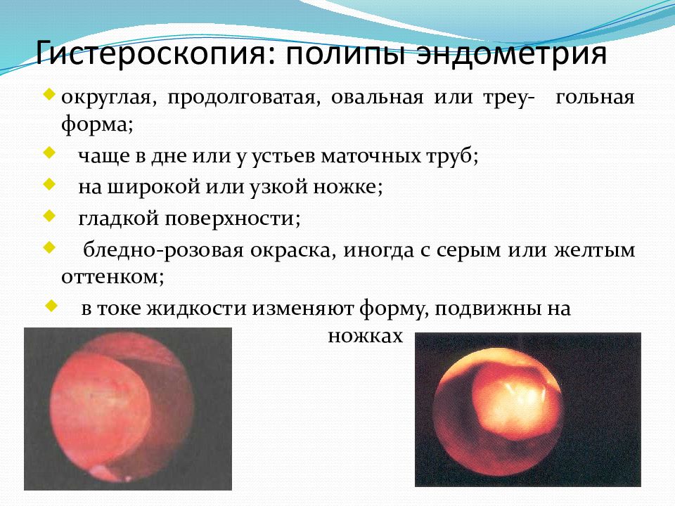 Удаление полипа в матке отзывы пациентов. Полип эндометрия гистероскопия.