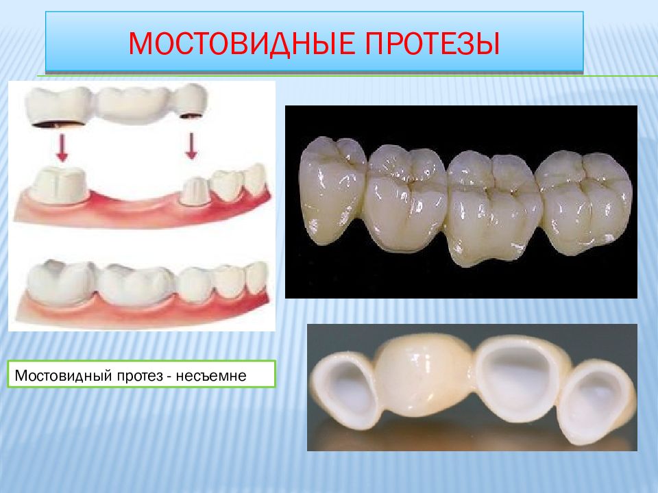 Стоматологическая керамика презентация