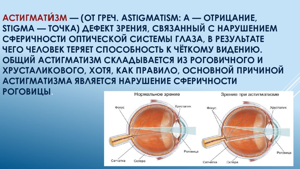 Астигматизм у детей. Астигматизм. Астигматизм физиология. Астигматизм глаз. Строение астигматического глаза.