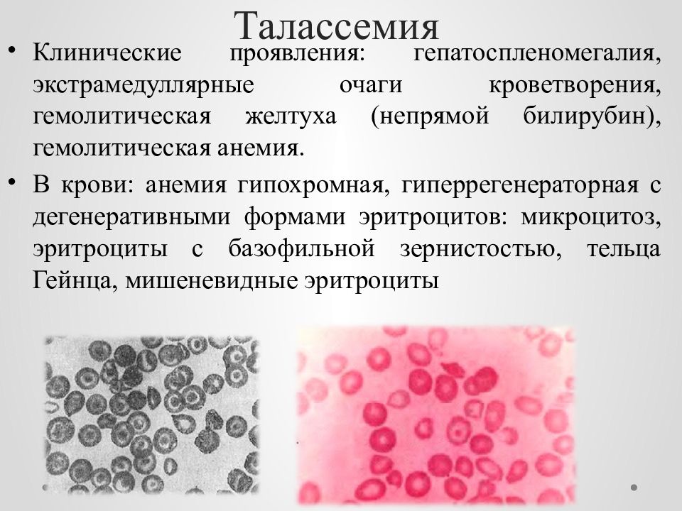 Тельца гейнца. Гемолитическая анемия картина крови. Картина крови при гемолитической анемии характеризуется. Картина крови при наследственной гемолитической анемии. Клинические проявления талассемии.