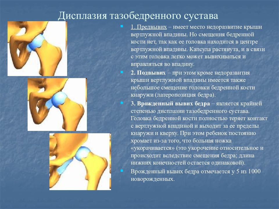 Дисплазия что это. Подвывих головки бедренной кости. Дисплазия крыши вертлужной впадины. Дисплазия вертлужной впадины тазобедренного сустава. Классификация дисплазии вертлужной впадины.