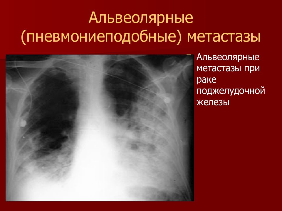 Лучевая диагностика опухолей поджелудочной железы презентация