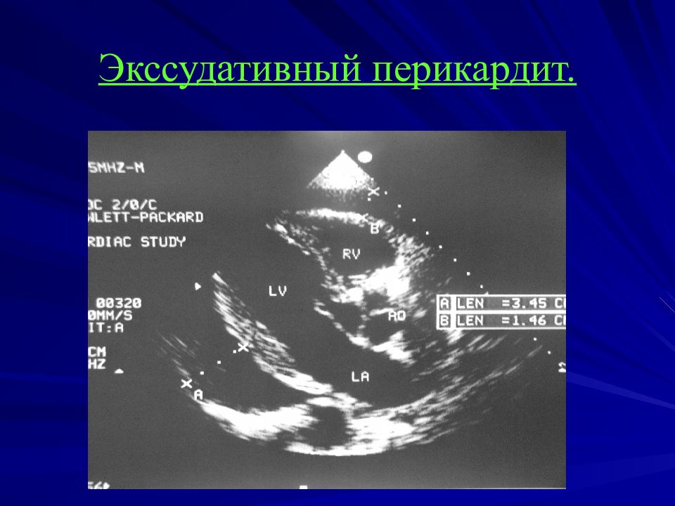 Выпотной перикардит. Эхокардиография при перикардите. Острый экссудативный перикардит ЭХОКГ. Экссудативный перикардит ЭХОКГ. Экссудативный перикардит рентген.