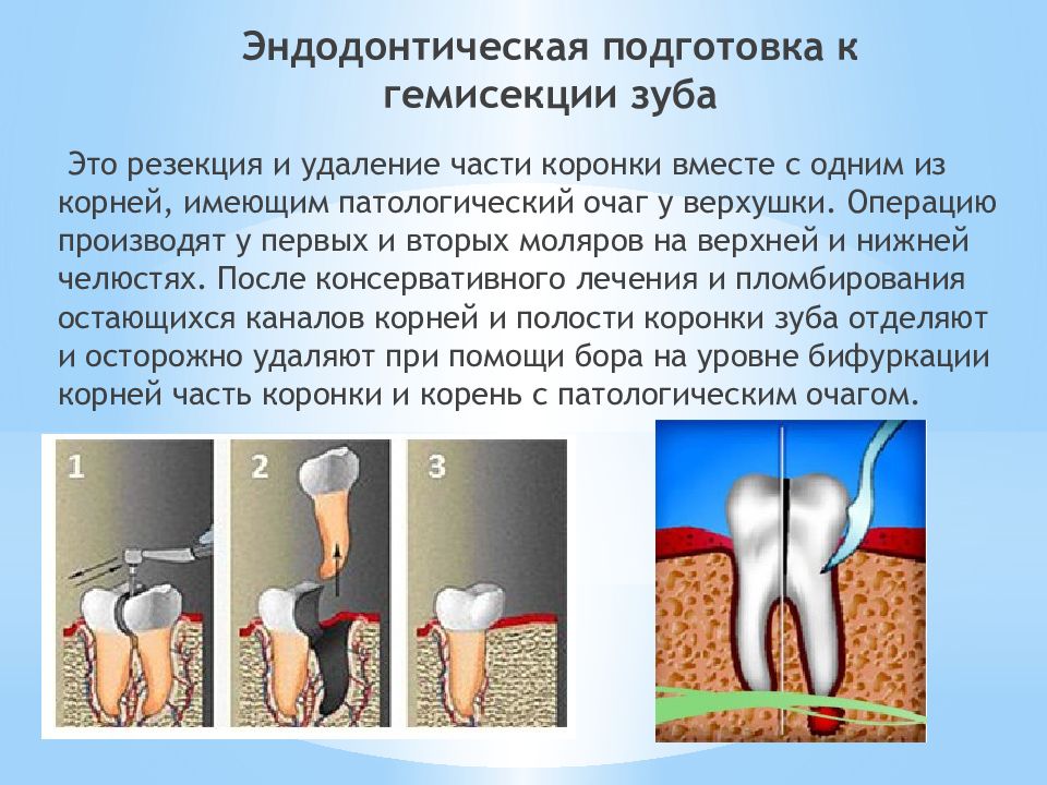 Хирургическое лечение периодонтитов презентация