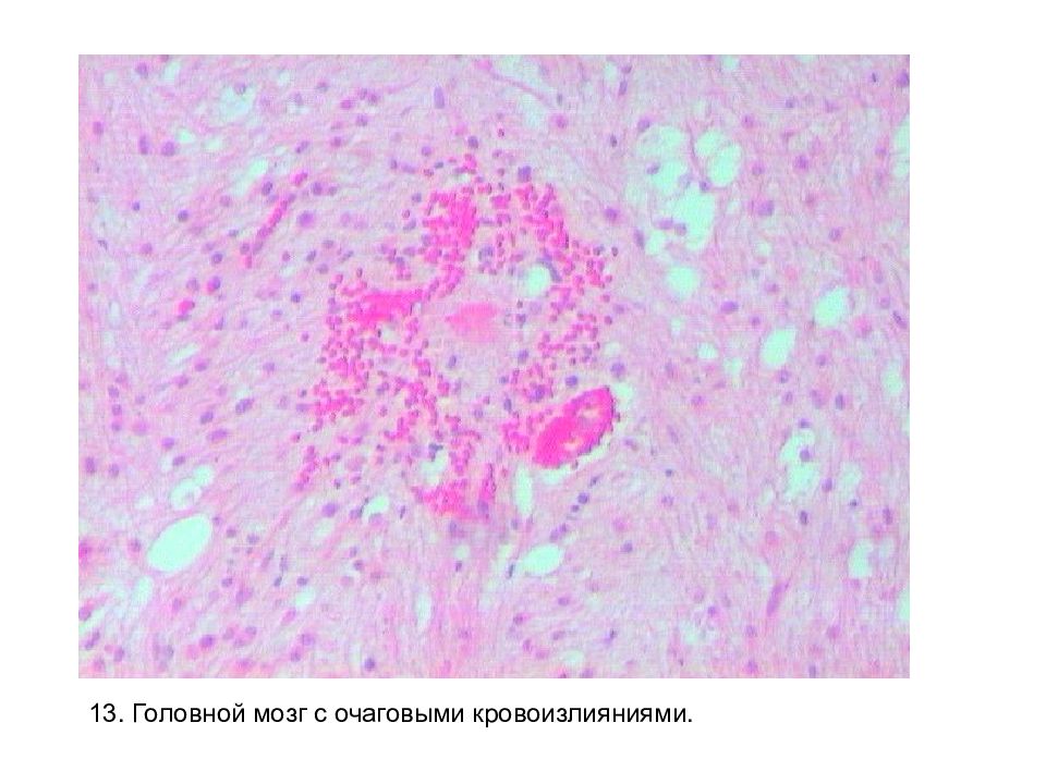 Кровоизлияние в мозг микроскопическая картина