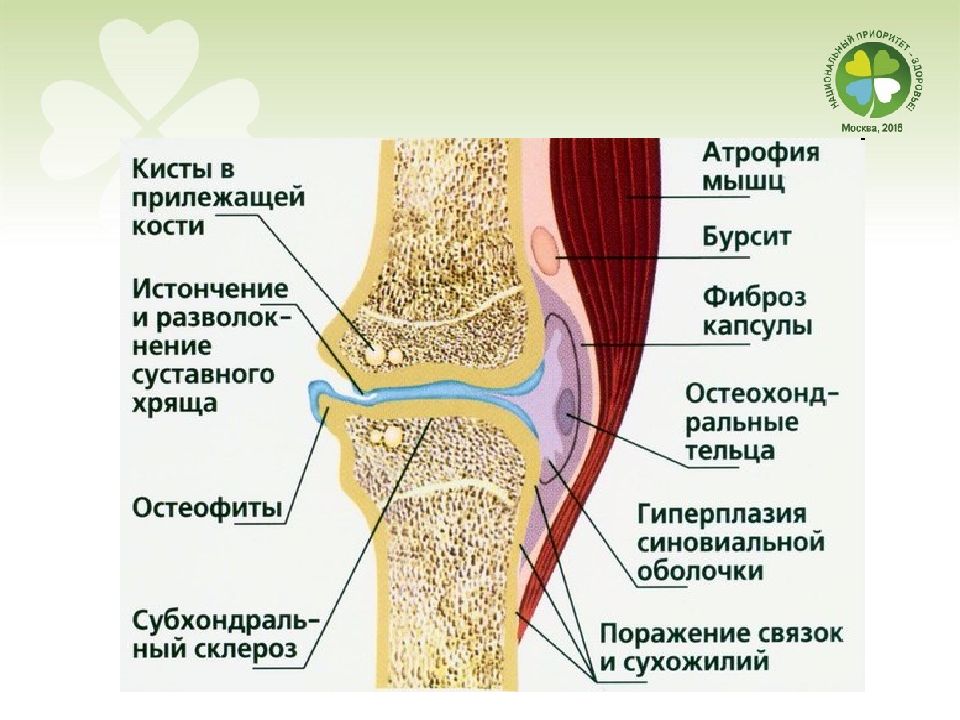 Патогенез остеоартроза презентация