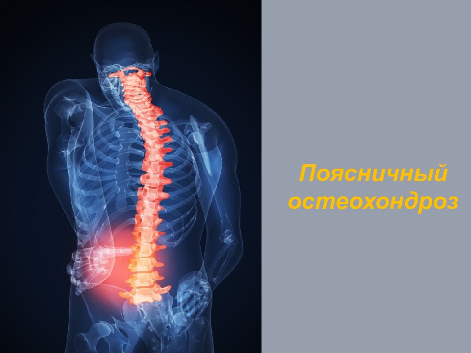 Остеохондроз поясничного отдела 1 периода. Поясничный остеохондроз. Остеохондроз фото. Фон для презентации остеохондроз. Фотосток остеохондроз.