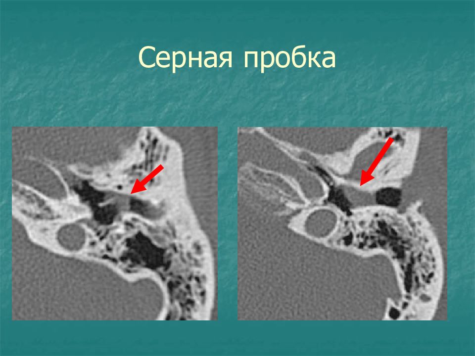 Кт височных костей. Холестеатома на кт височных костей. Кт сосцевидного отростка височной кости. Стенки пирамиды височной кости кт. Гранулема наружного слухового прохода кт.