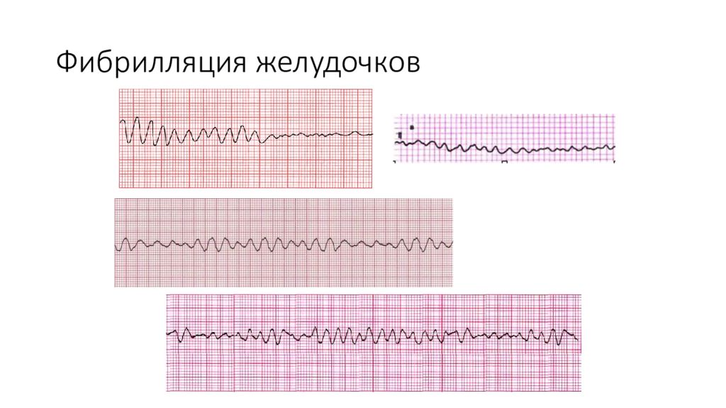 Мелковолновая фибрилляция желудочков ЭКГ. Крупноволновая фибрилляция желудочков на ЭКГ. Мелковолновая фибрилляция желудочков лечение. Мелковолновая фибрилляция СЛР.