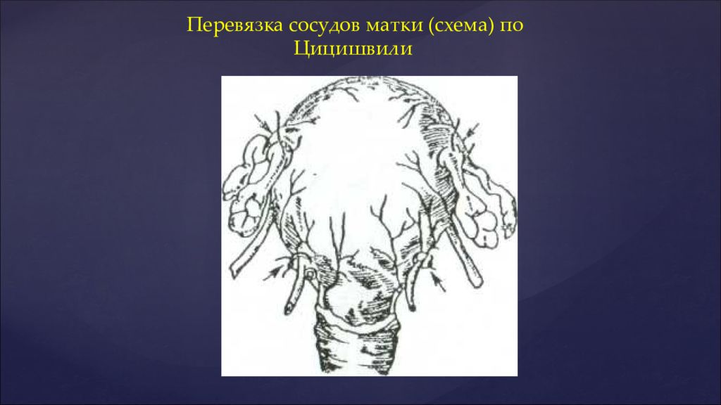 Сосуды матки. Перевязка маточных сосудов по Цицишвили. Превязкасосудов матки. Перевязка яичниковой артерии.