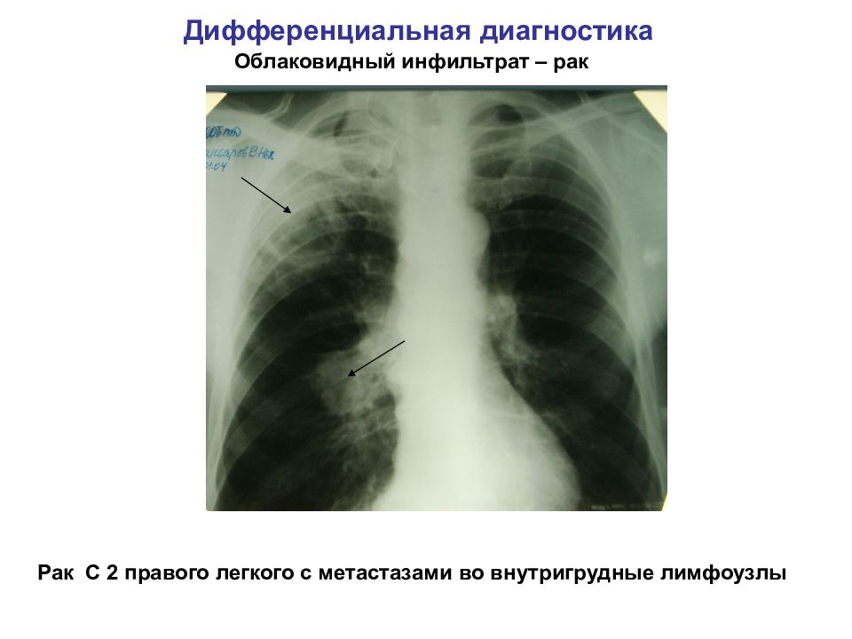 Дифференциальная диагностика при легочном инфильтрате презентация