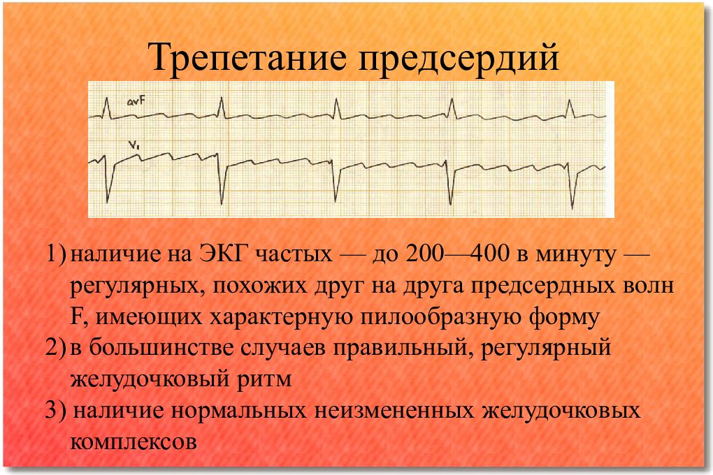 Волны при трепетании предсердий. Трепетание предсердий 2 к 1 на ЭКГ. Трепетание предсердий ЭКГ ЧСС 200. Трепетание предсердий и желудочков на ЭКГ. Трепетание предсердий 1 к 1 на ЭКГ.