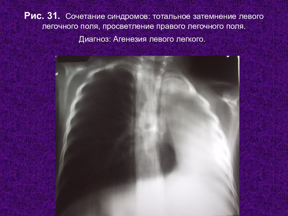 Просветление в легких. Субтотальное затемнение легкого рентген. Рентген тотальное затемнение легкого. Тотальное и субтотальное затемнение легочного поля. Затемнение легочного поля.