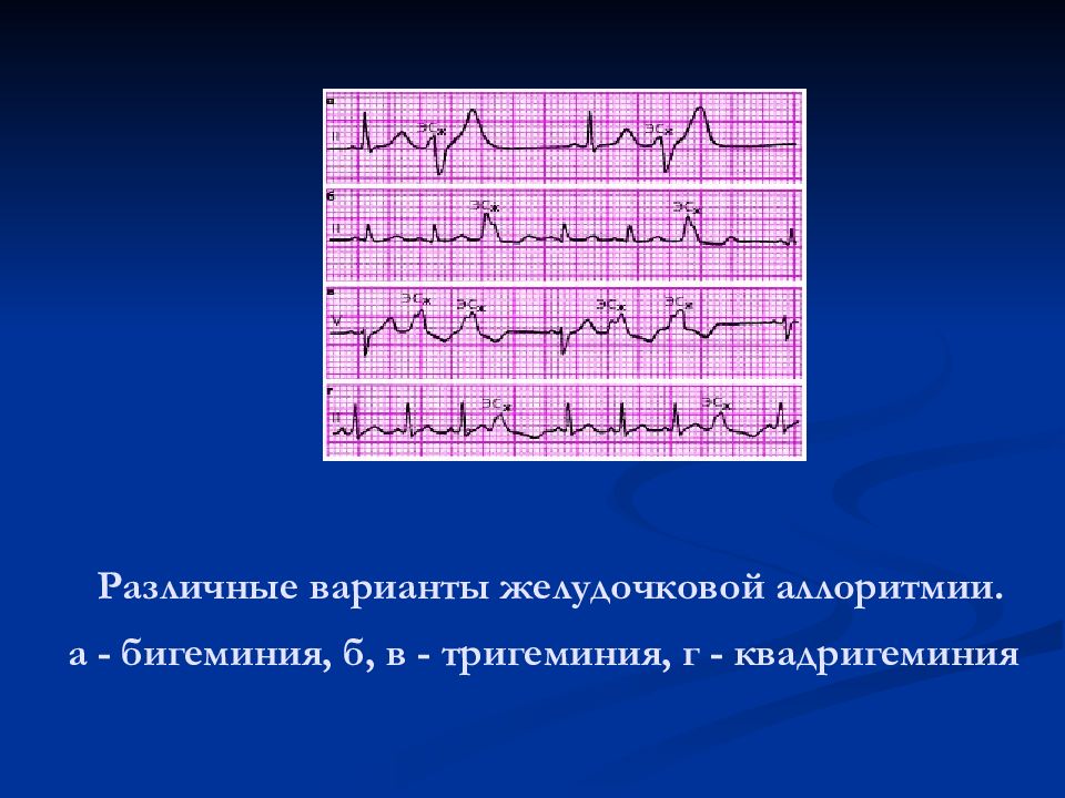 Нарушение ритма по типу бигеминии карта вызова